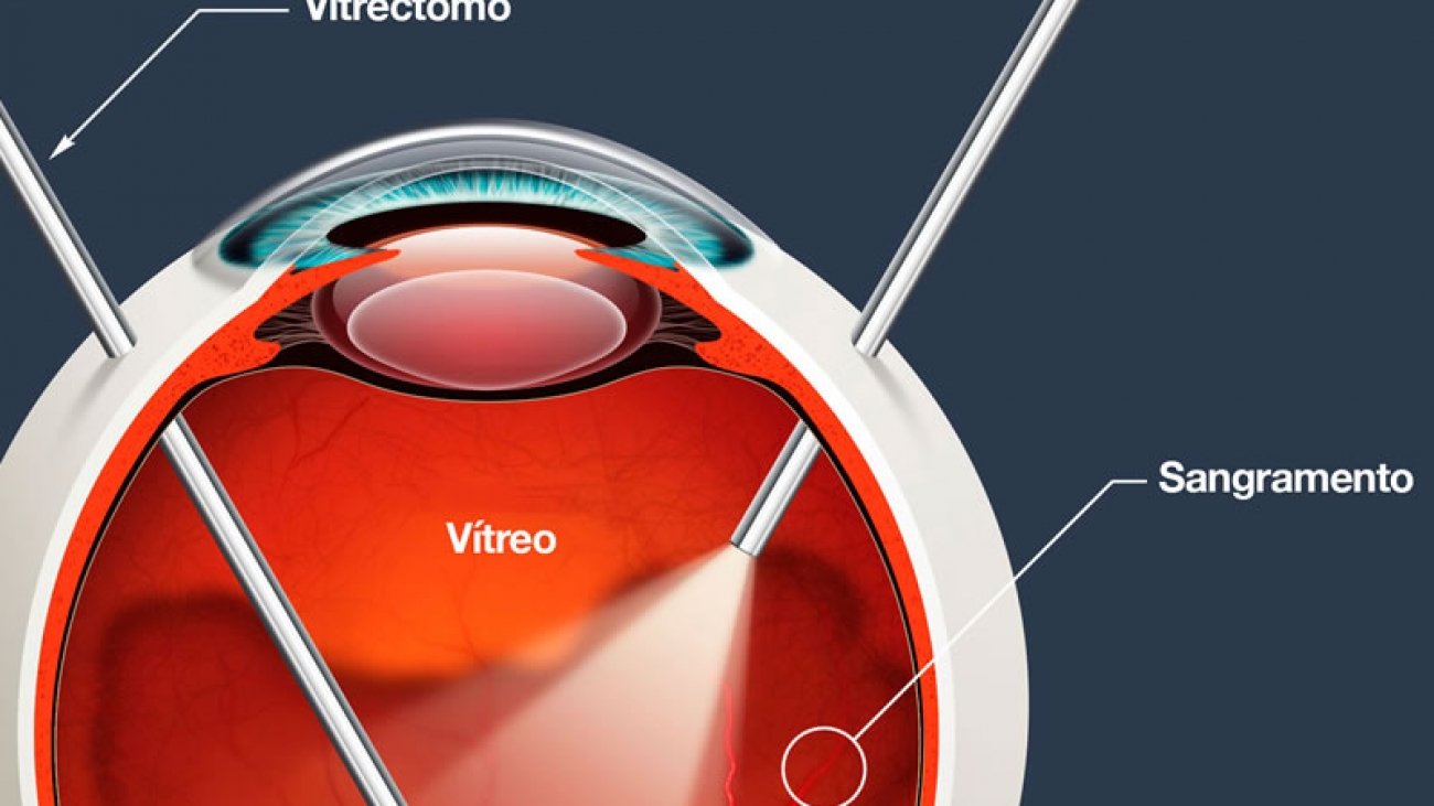 vitrectomia posterior