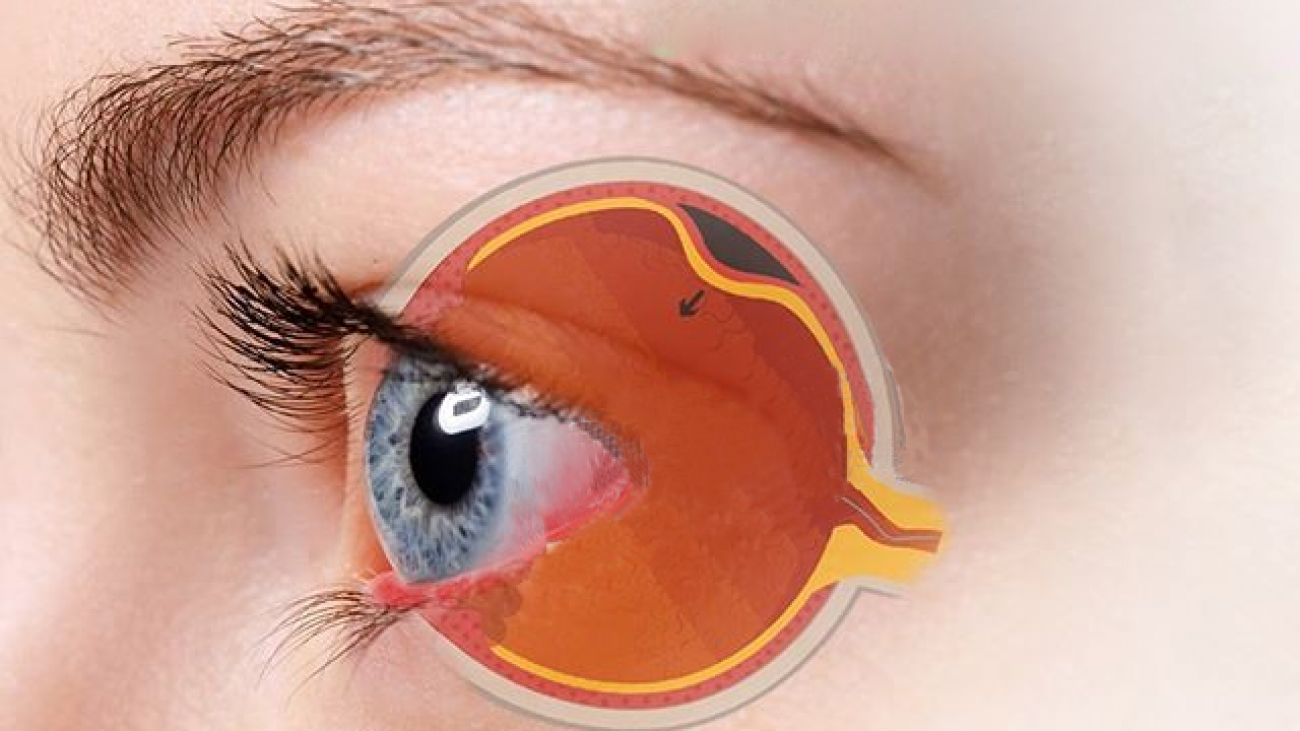 descolamento de retina